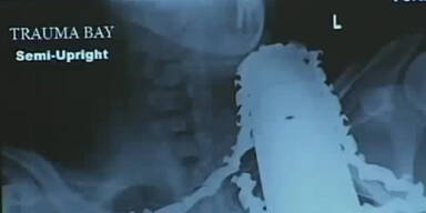 Kettensäge steckt im Hals: Unfall überlebt