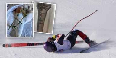 Alles viel schlimmer! Skifahrerin Fleckenstein postet Horror-Verletzung