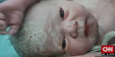 Bomben-Baby von Aleppo wird leben