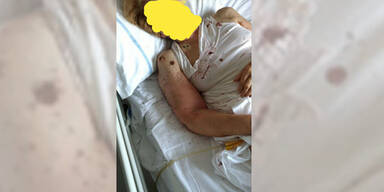 Schock-Foto von Ameisen-Attacke in Spital