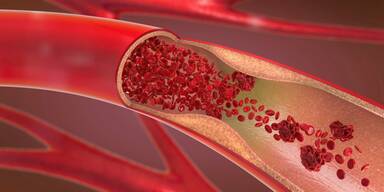 Daran erkennen Sie, dass Sie Arteriosklerose haben