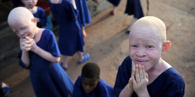 Albino Kinder Tansania