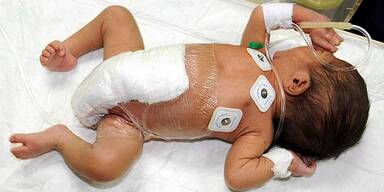 Ärzte operierten Baby mit sechs Beinen