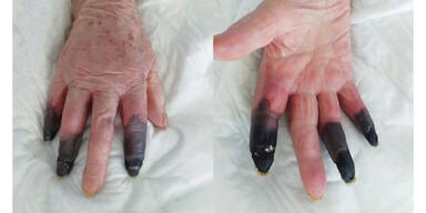 Italienerin verliert Finger nach Corona-Infektion