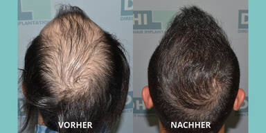 Vorher- und Nachher Foto einer Haartransplantation mit DHI-Methode