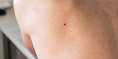 Sind kleine, rote Punkte auf der Haut gefährlich?