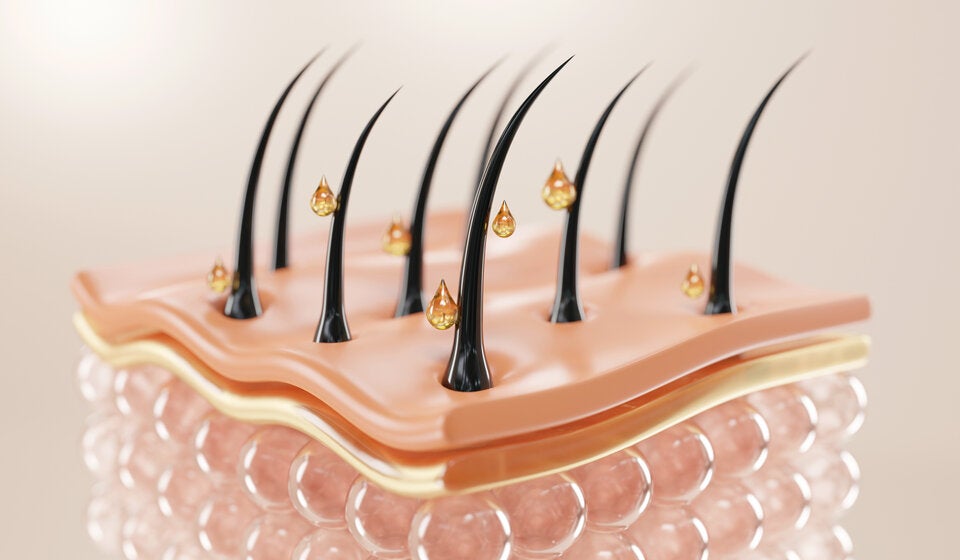 Als Therapie bei genetisch und hormonell bedingtem Haarausfall hat sich das Mittel „Minoxidil“ bewährt.