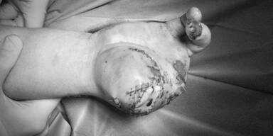 Warnung: Klinik schockt mit zerfetzter Böller-Hand