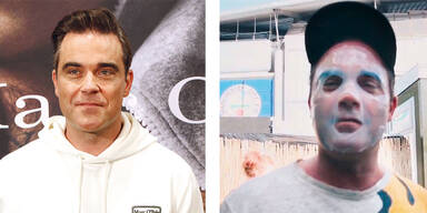 Robbie Williams Botox
