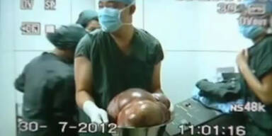 China: Frau wurde 12,5 kg-Tumor entfernt