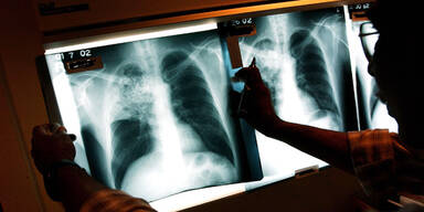 2015 sogar weniger Tuberkulose-Fälle in Österreich