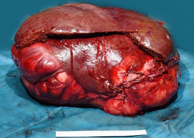 Tumor