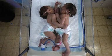 Siamesische Zwillinge im Gazastreifen geboren