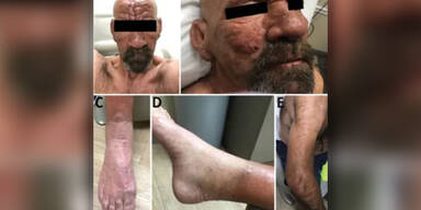 USA: Fälle von Lepra nehmen zu