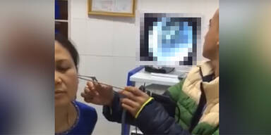 Frau geht wegen Schmerzen zum Arzt - DAS fand er im Ohr
