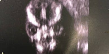 Ultraschall: Fötus sieht aus wie Lord Voldemort