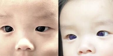 Nach Einnahme von Corona-Medikament: Augen von Baby färben sich blau