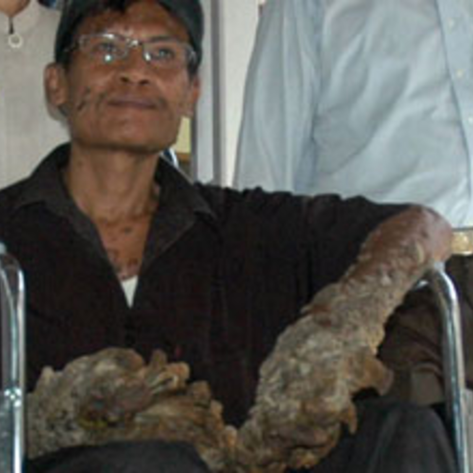 dede koswara after surgery