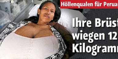 Peruanerin hat 12 Kilo schwere Brüste