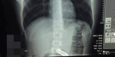 lachgas röntgen