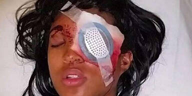 Polizei schießt Frau ein Auge weg