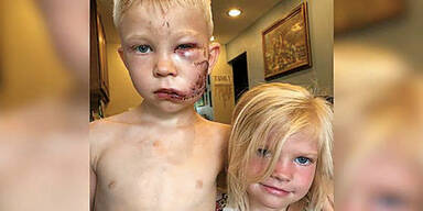 Bruder rettete Schwester vor Hunde-Attacke