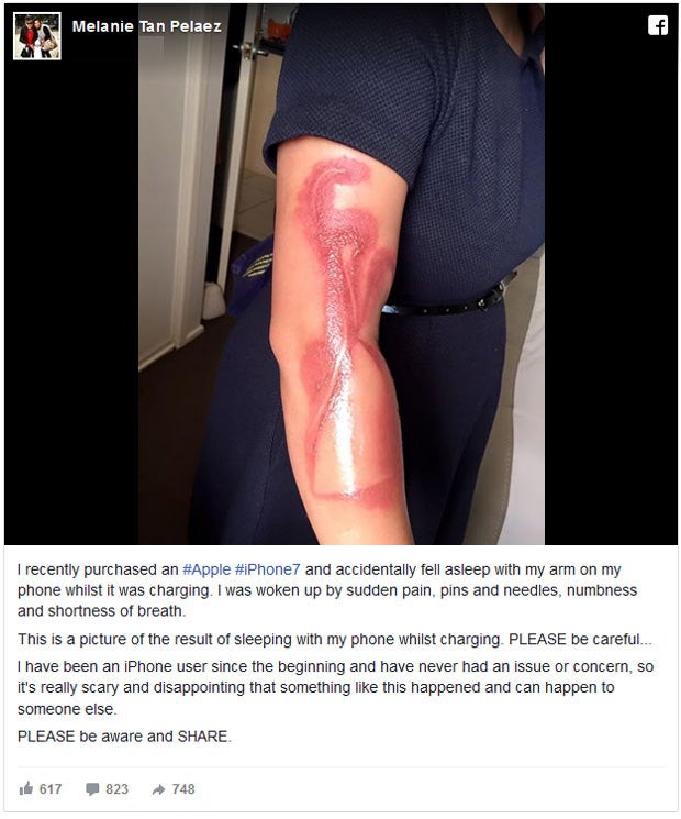 iPhone 7 verbrennt Frau den Arm