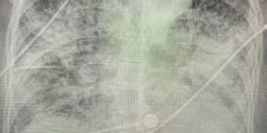 Schock-Bild zeigt Lunge eines Corona-Patienten