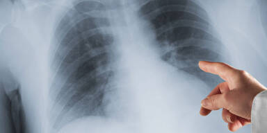 Lungenkrebspatienten "top" versorgt