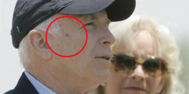 Hat McCain Hautkrebs?