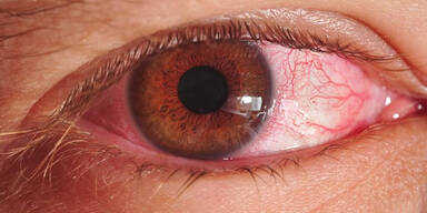 Warnung: Aggressive Augengrippe im Umlauf