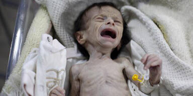 Die hungernden Babys von Syrien
